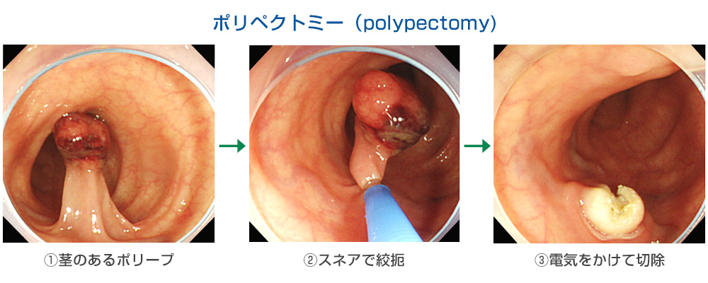 大腸ポリープ切除術の種類 【なら内視鏡クリニック】日帰り大腸ポリープ切除・楽な胃・大腸カメラ・奈良駅前