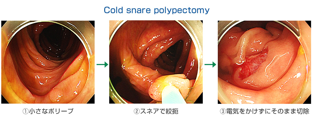 大腸ポリープ切除術の種類 【なら内視鏡クリニック】日帰り大腸ポリープ切除・楽な胃・大腸カメラ・奈良駅前