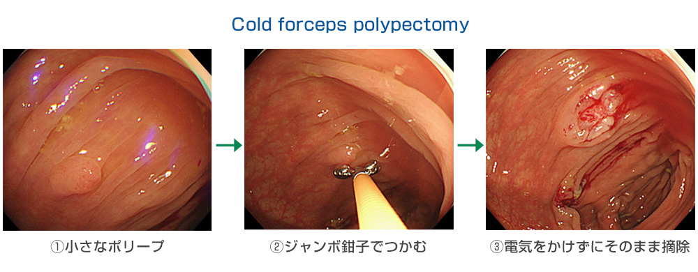 9+ 内 視 鏡 的 大腸 ポリープ 粘膜 切除 術 保険 References
