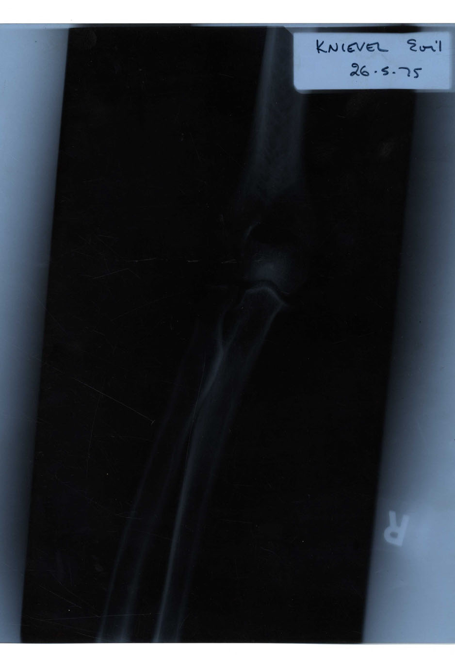 Lot Detail OneofaKind Evel Knievel Right Elbow XRay Taken