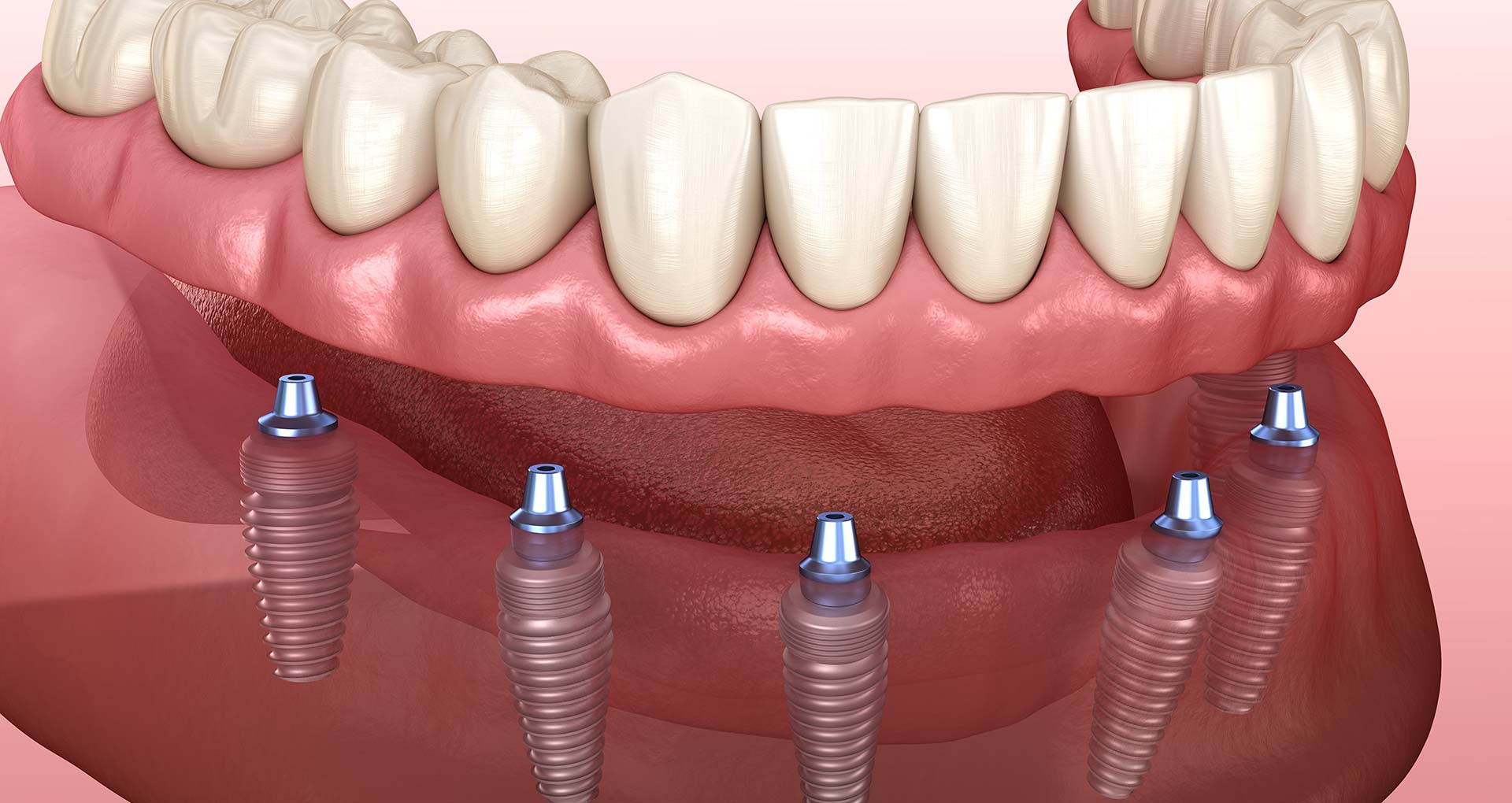 FullArch Dental Implant Procedure Dental Implants In One Day and One