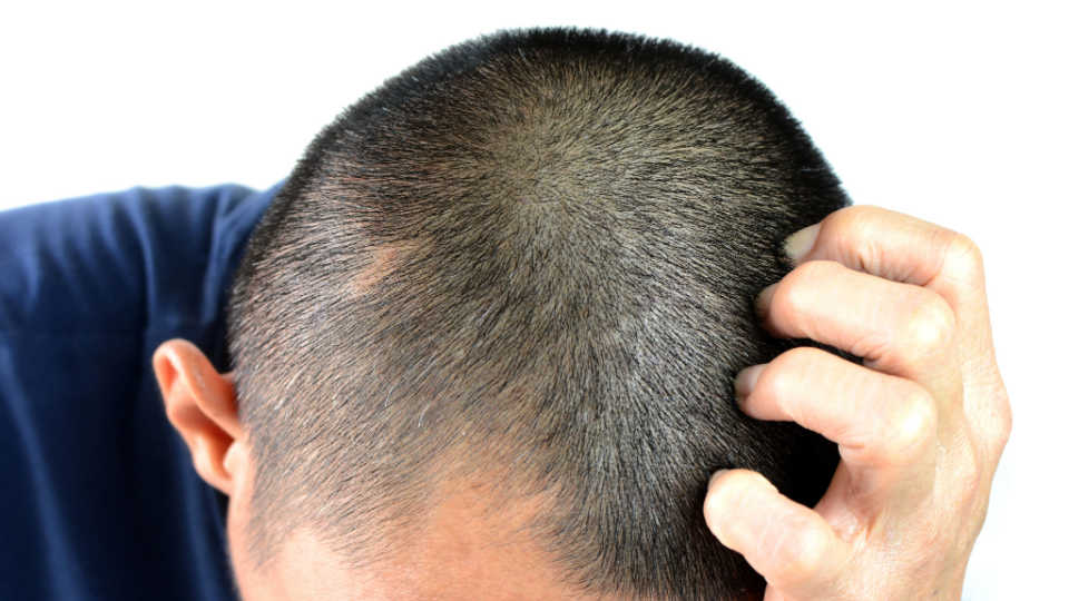 Why does your scalp itch?