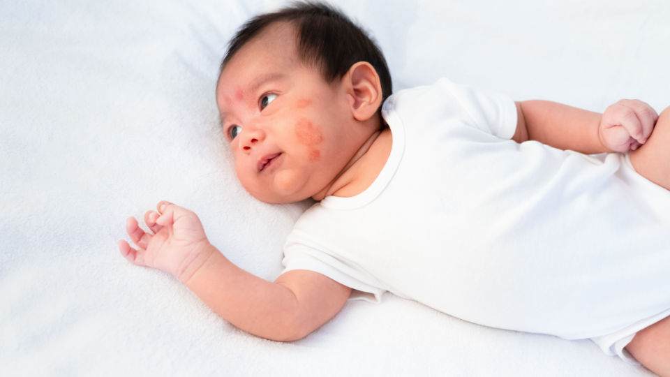 Is it Possible to Prevent Atopic Dermatitis? National Eczema Association