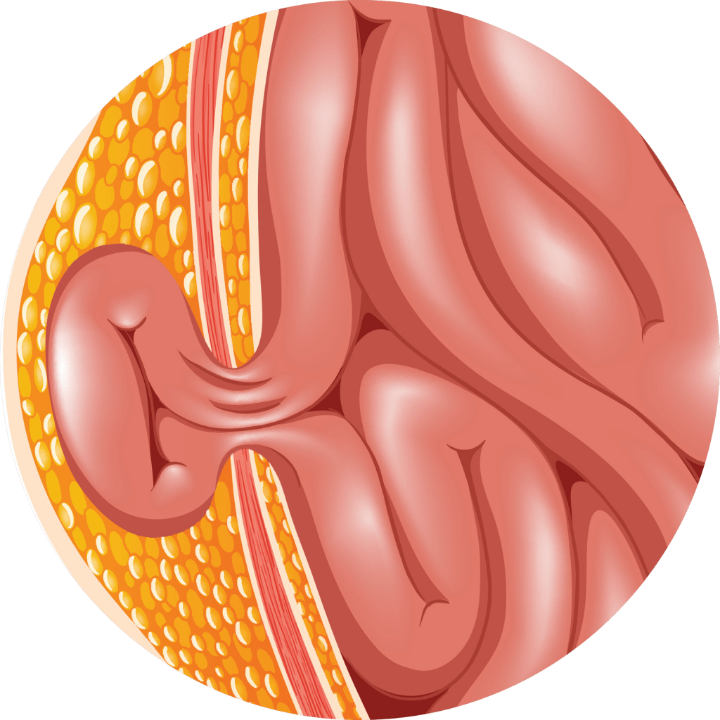 National Hernia Institute Hernia Types
