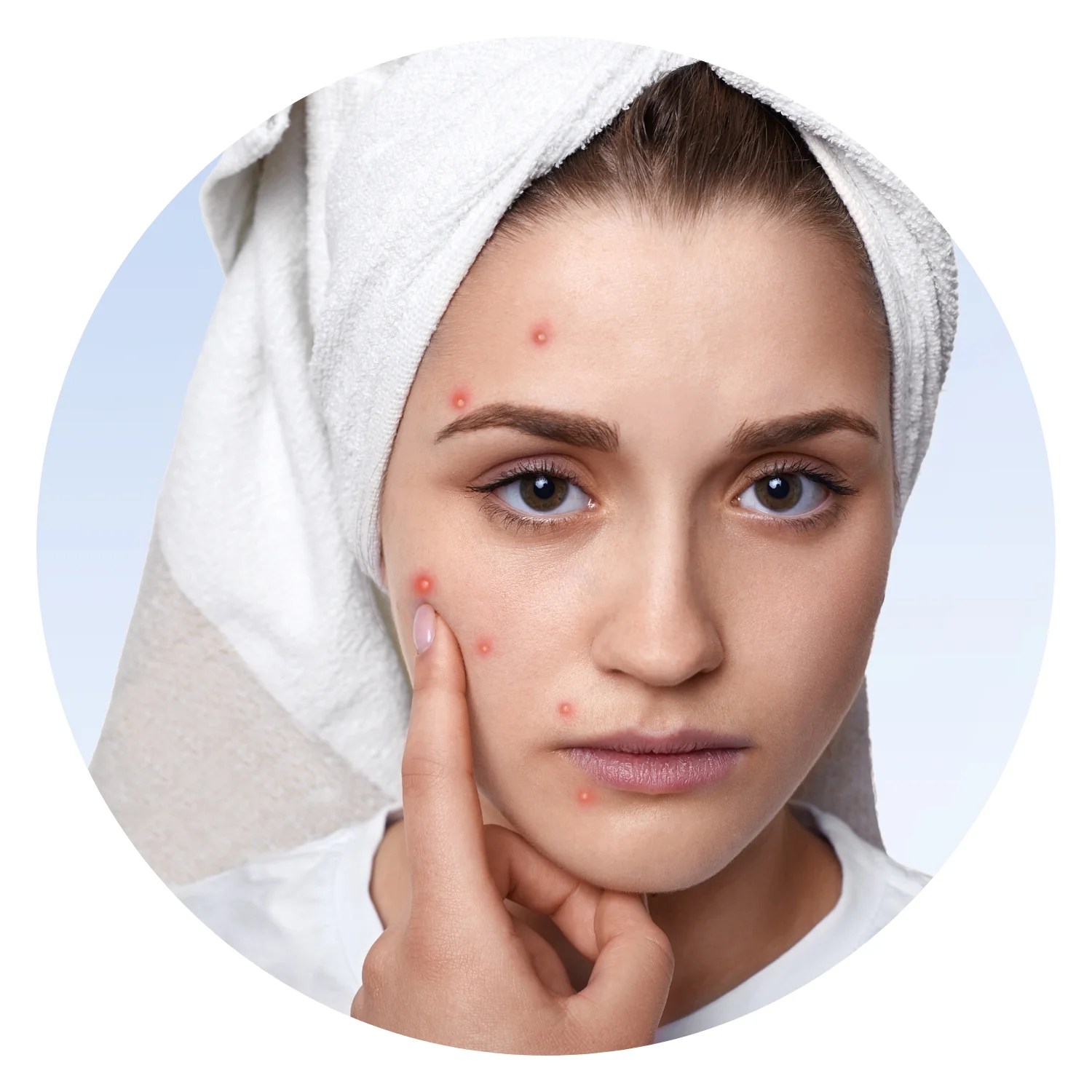 Clear Skin Ahead Solutions for AcneProne Skin Nattoral