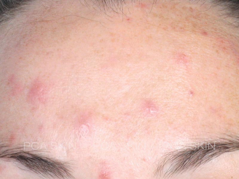 Chemical Peels