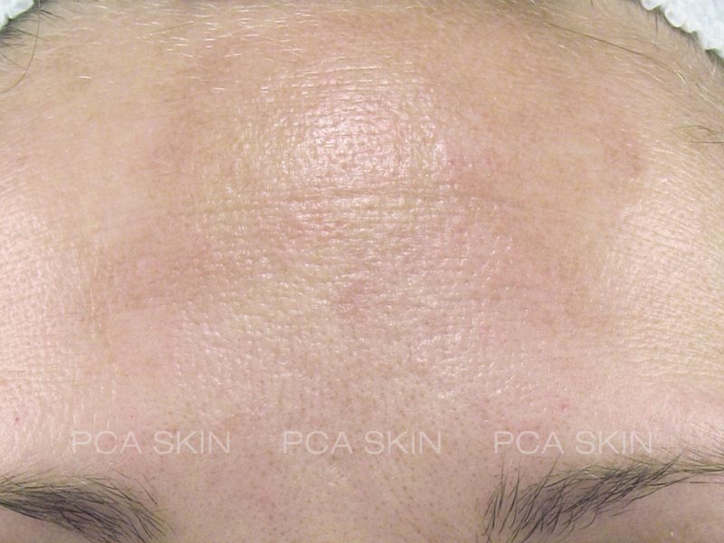 Chemical Peels