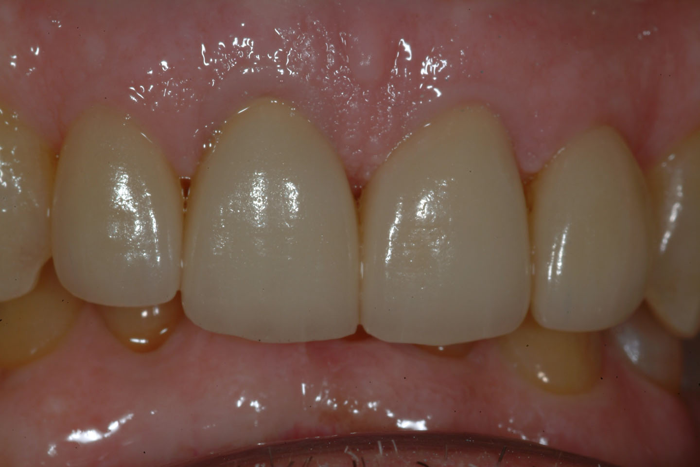 Case 1 « Natural Esthetics Dental Lab