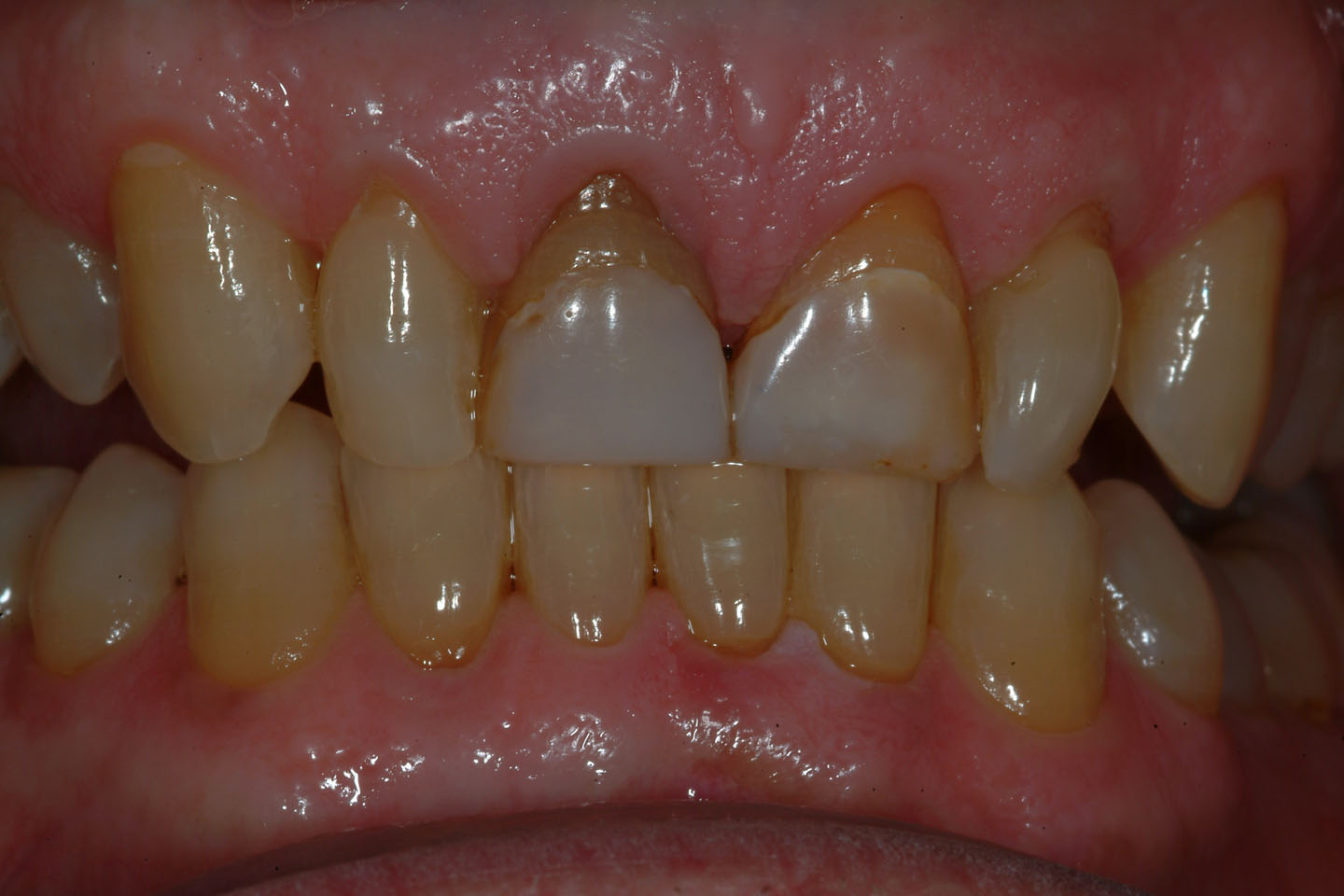 Case 1 « Natural Esthetics Dental Lab