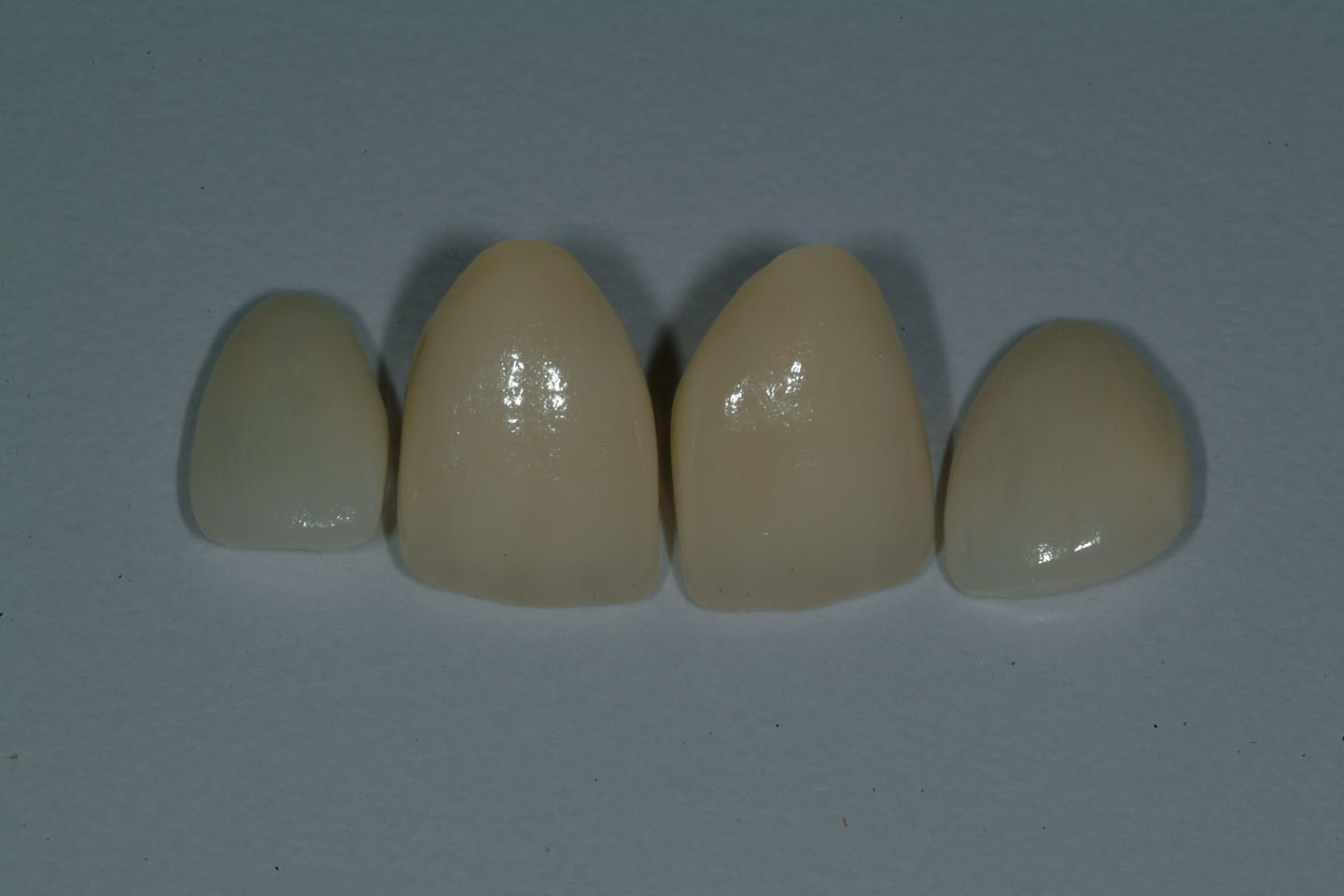 Case 1 « Natural Esthetics Dental Lab