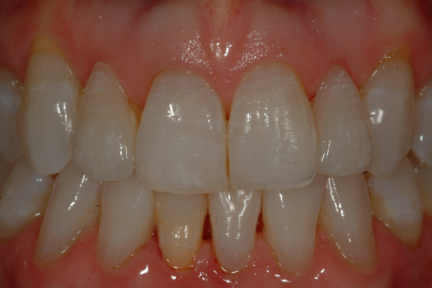 Case 6 « Natural Esthetics Dental Lab