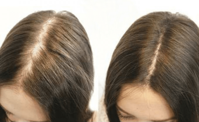 Remedio natural para detener la perdida de cabello y
