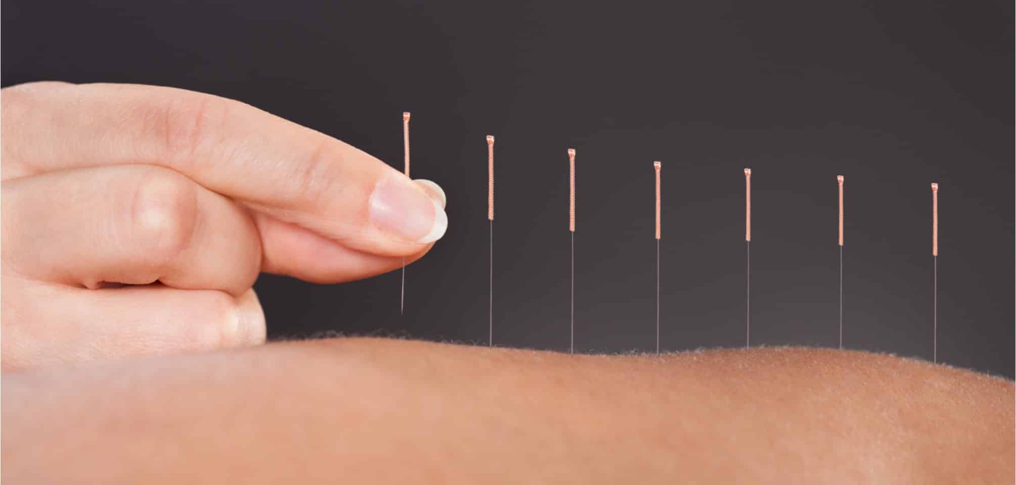 THE POWER OF ACUPUNCTURE Natural Synergy