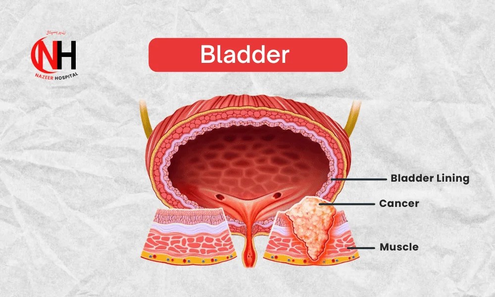 Bladder Cancer Nazeer Hospital