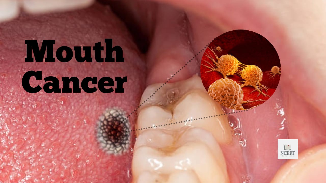 Mouth Cancer Symptoms and Treatment NCERT Infrexa