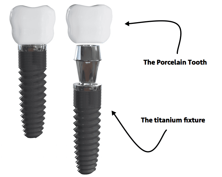 Dental Implants Oral Surgery Services at NCOSO One Stage Implants