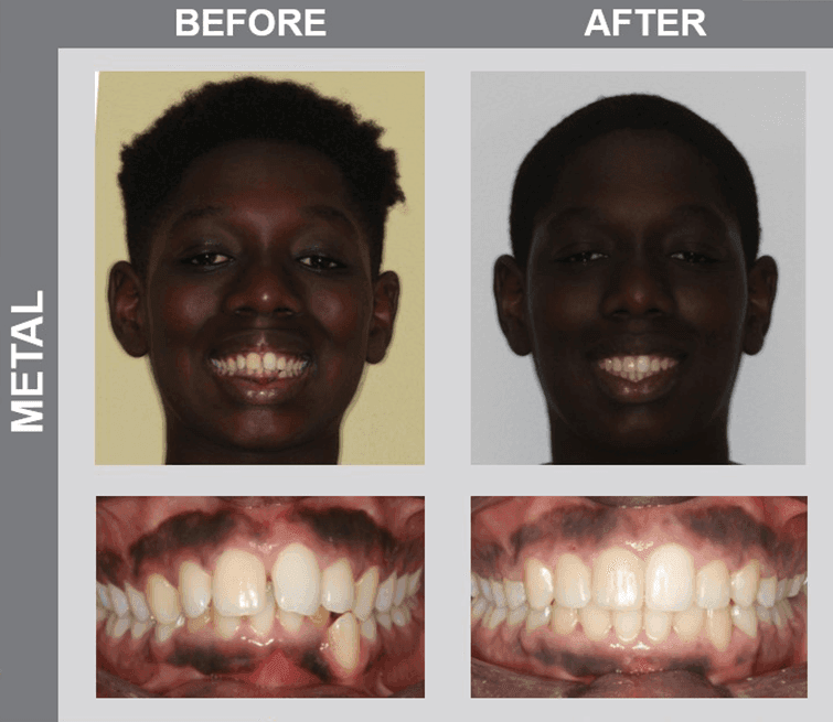 Smile Gallery Before and Afters NCOSO Orthodontics