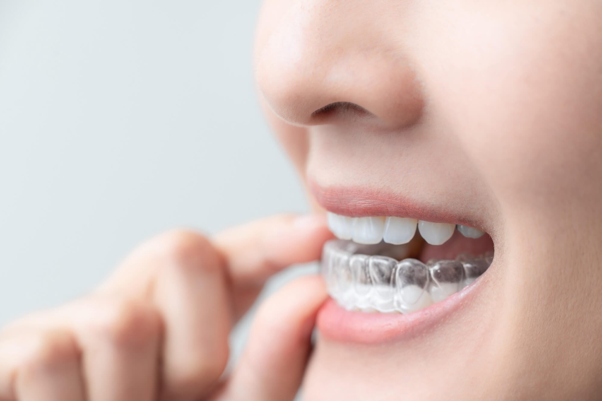 Are Invisalign Retainers Supposed to be Tight? NCOSO Orthodontics