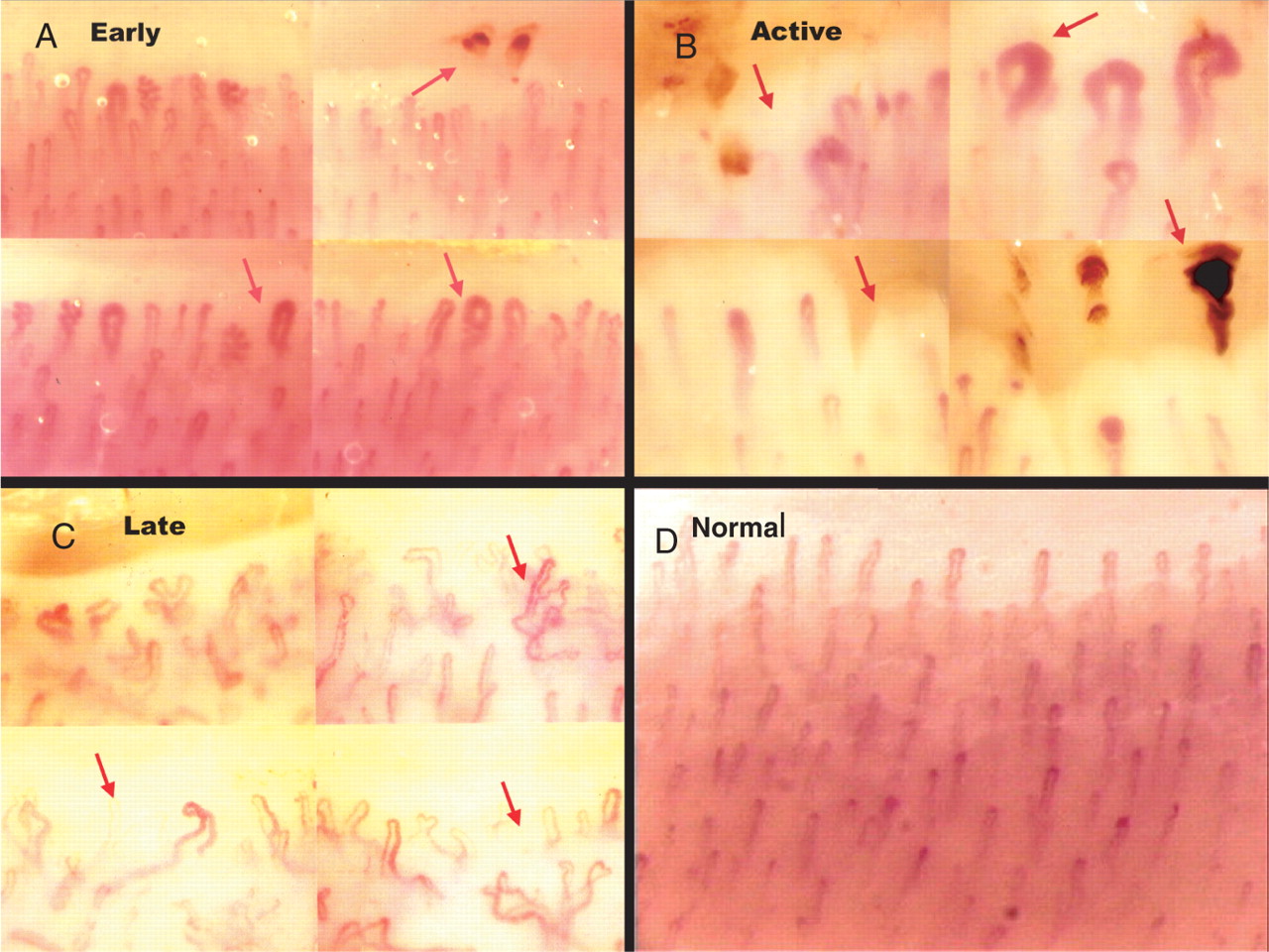 Nail Fold Capillaryscopy (NFC) National Center for Rheumatic Diseases