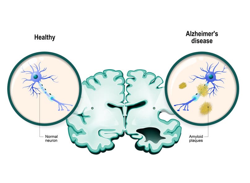 Cholesterol in Brain Regulates Alzheimer’s Plaquing Naturopathic