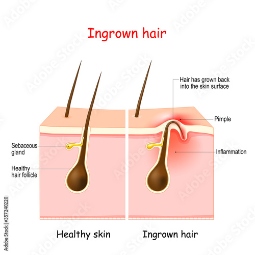 Ingrown Hairs On Men Symptoms, Causes And Treatment