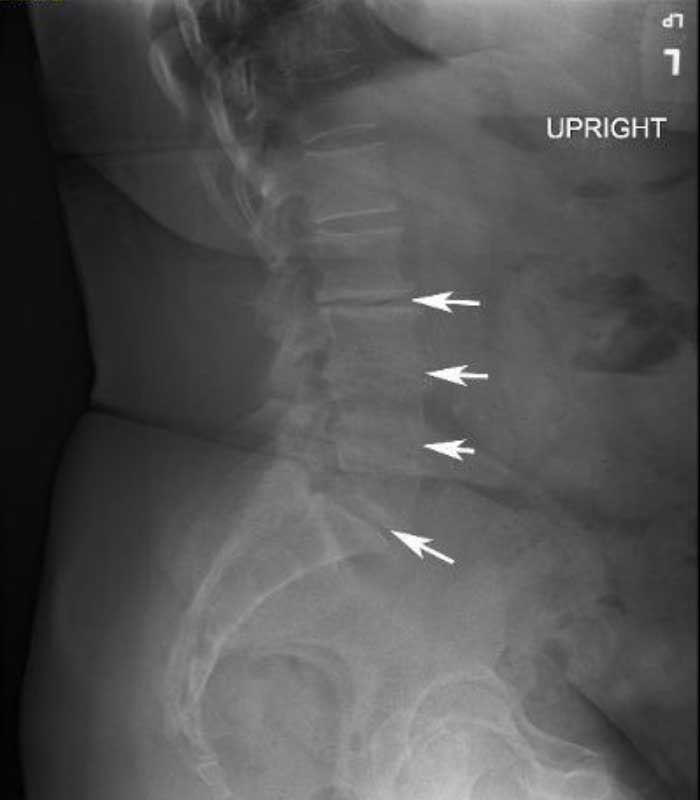 Far Lateral Lumbar Spine Fusions Oblique Lateral Interbody Fusion