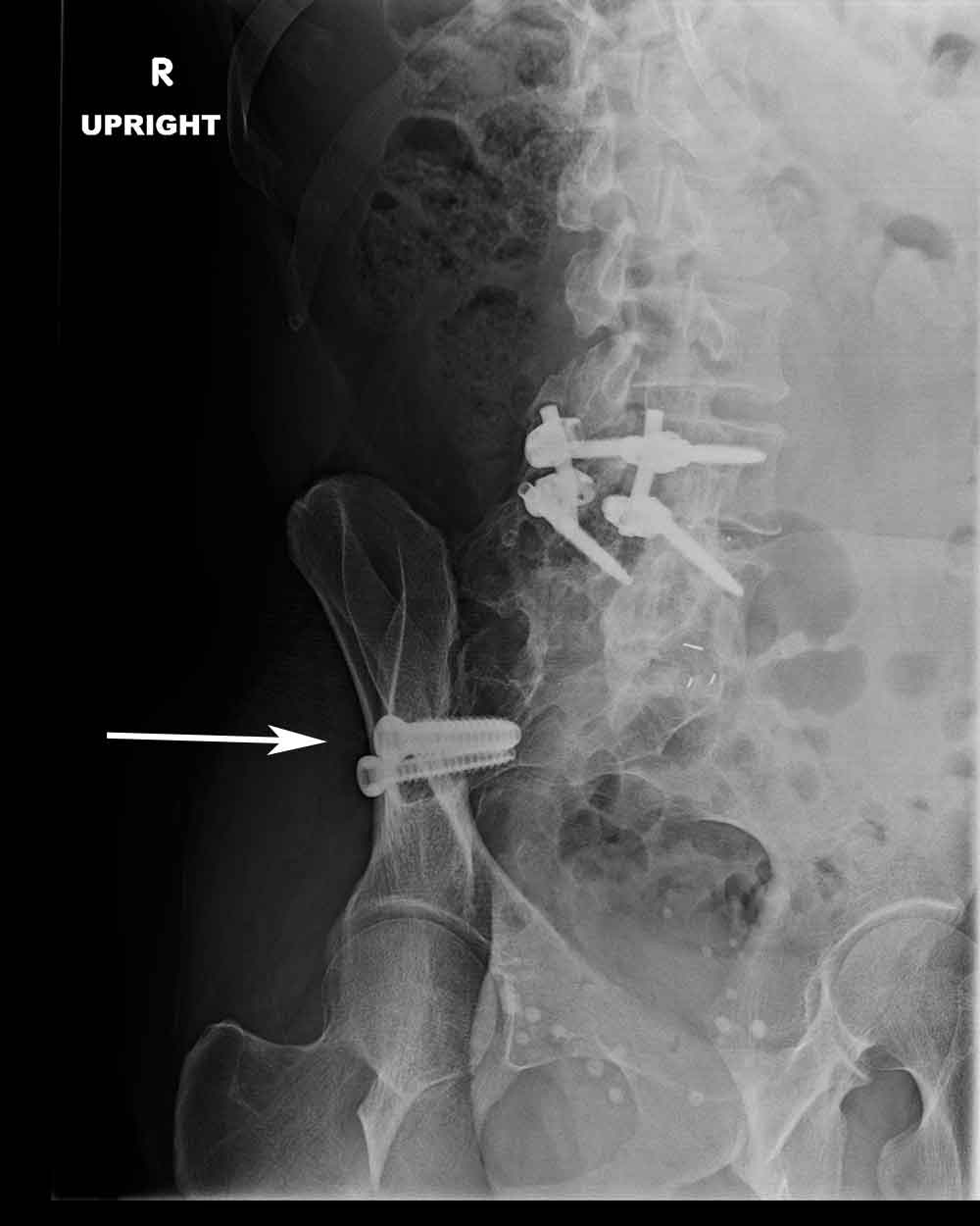 Sacroiliac Joint Fusion Spine Surgeon Vail, Aspen, Denver CO