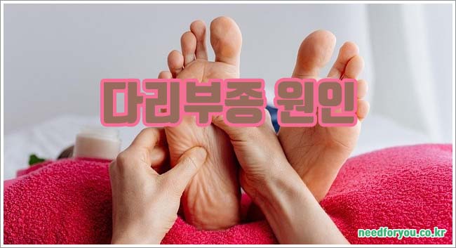 다리부종 원인과 효과적인 영양제 안내
