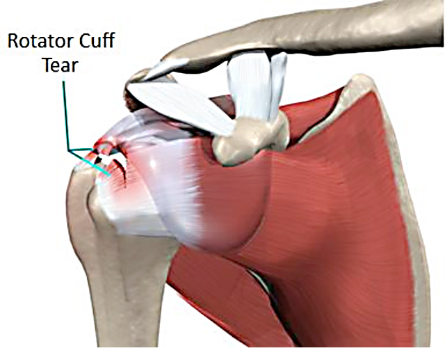 rotatorcuff2 Dr Neil Craton