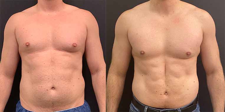 Before &amp, After Male Liposuction Results Neinstein Plastic Surgery