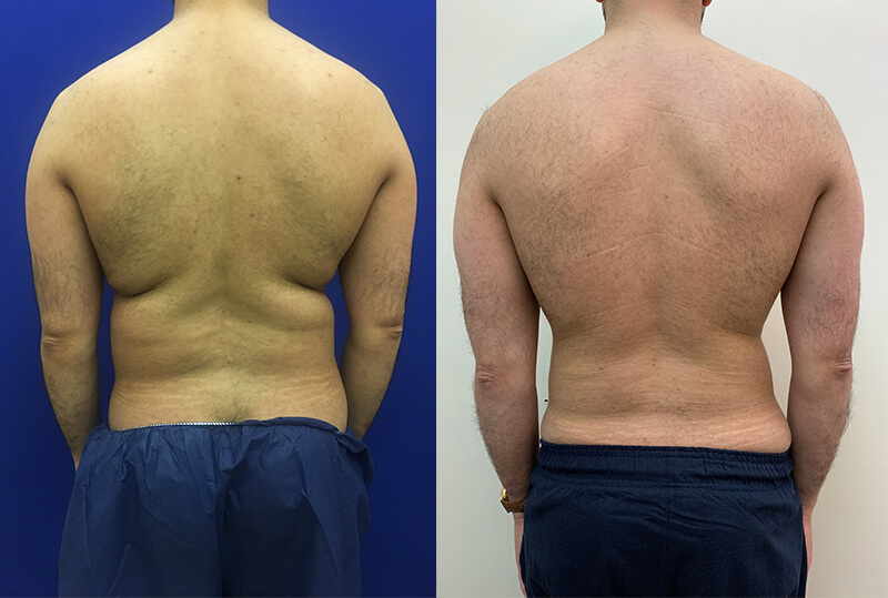 Before & After Male Liposuction Results Neinstein Plastic Surgery