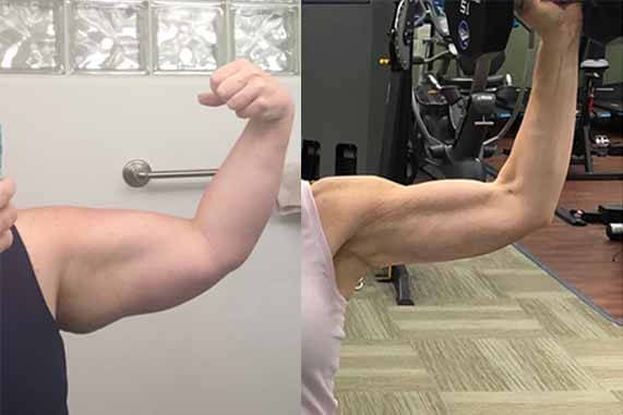 Mini Arm Lift in NYC Lipo Specialist Neinstein Plastic Surgery