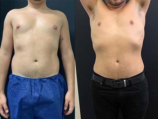 Before & After Male Liposuction Results Neinstein Plastic Surgery
