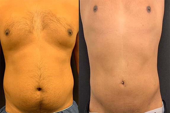 Before & After Male Liposuction Results Neinstein Plastic Surgery