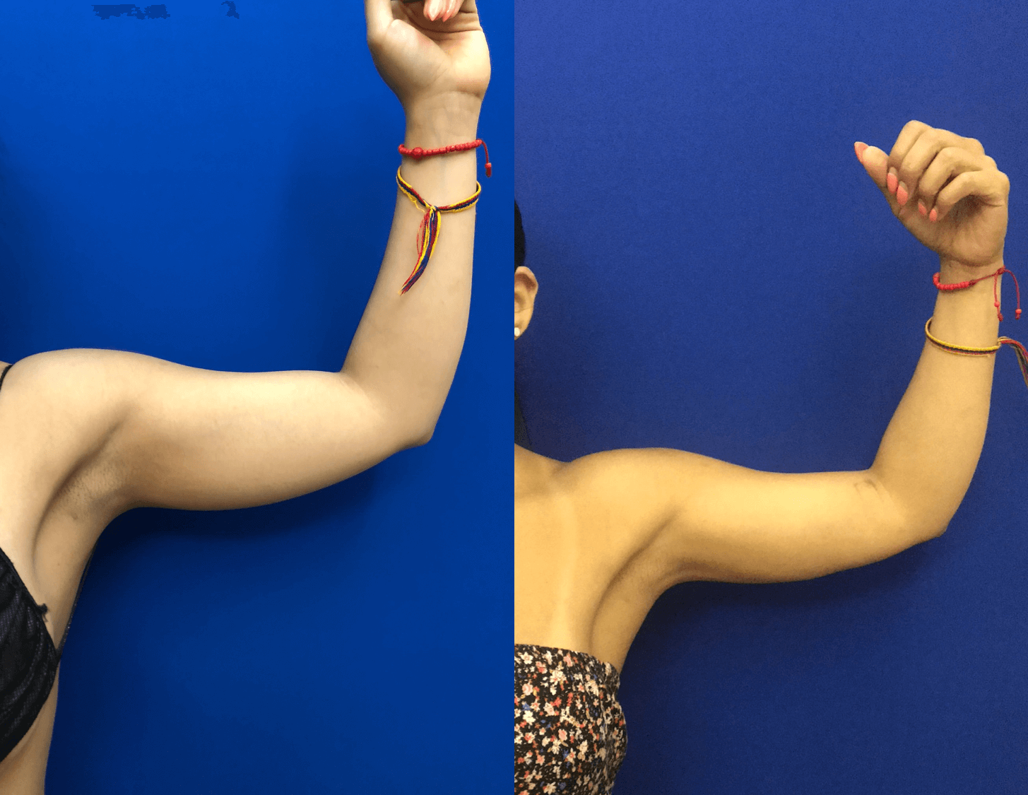 Before & After Arms Liposuction Neinstein Plastic Surgery