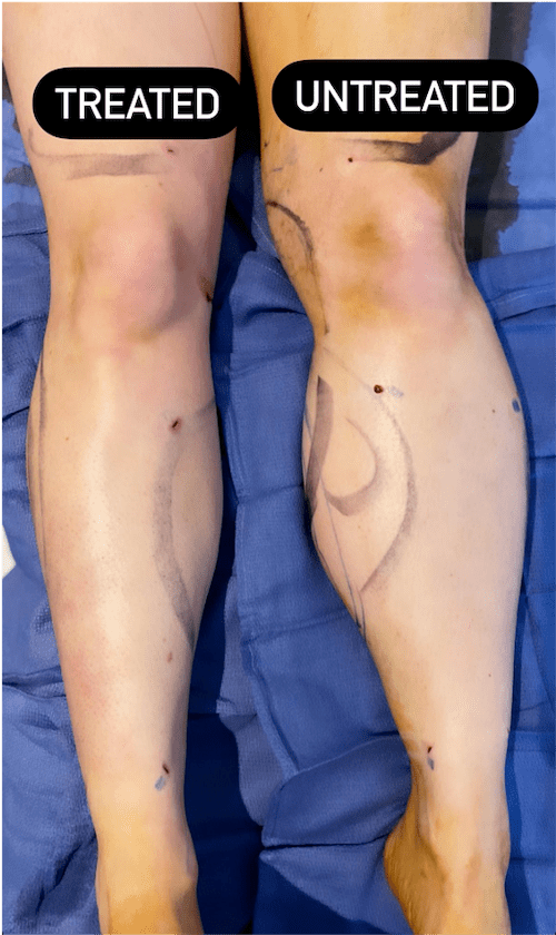 Before & After Calf & Ankle Liposuction Neinstein Plastic Surgery