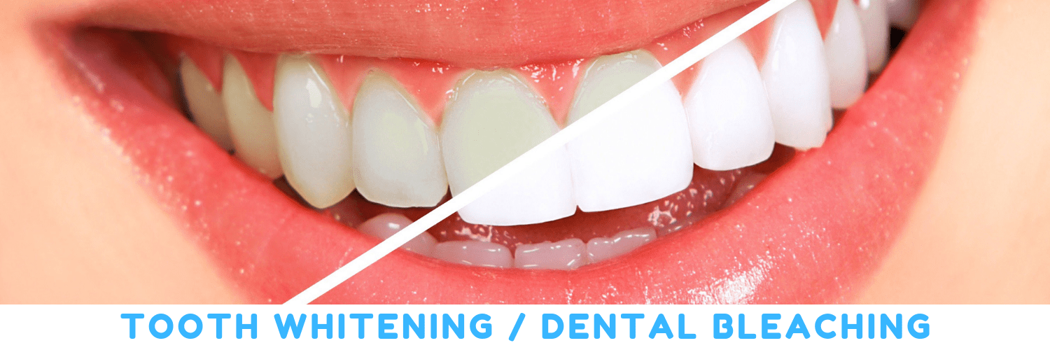 Dental Bleaching Tooth Whitening Treatment in Bellandur, Bangalore