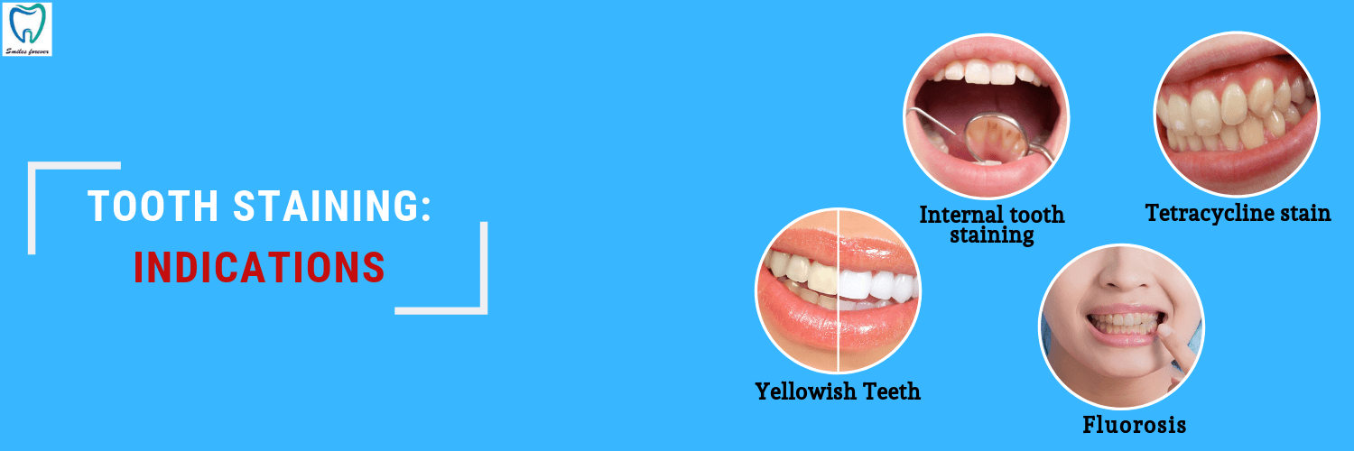 Dental Bleaching Tooth Whitening Treatment in Bellandur, Bangalore