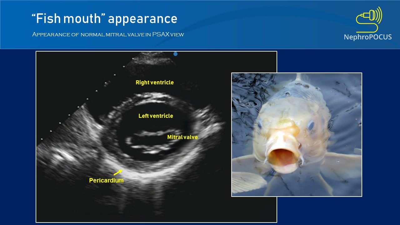 fishmouth NephroPOCUS