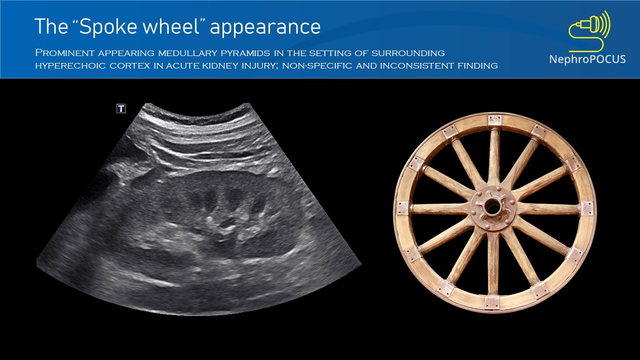 spokewheel NephroPOCUS