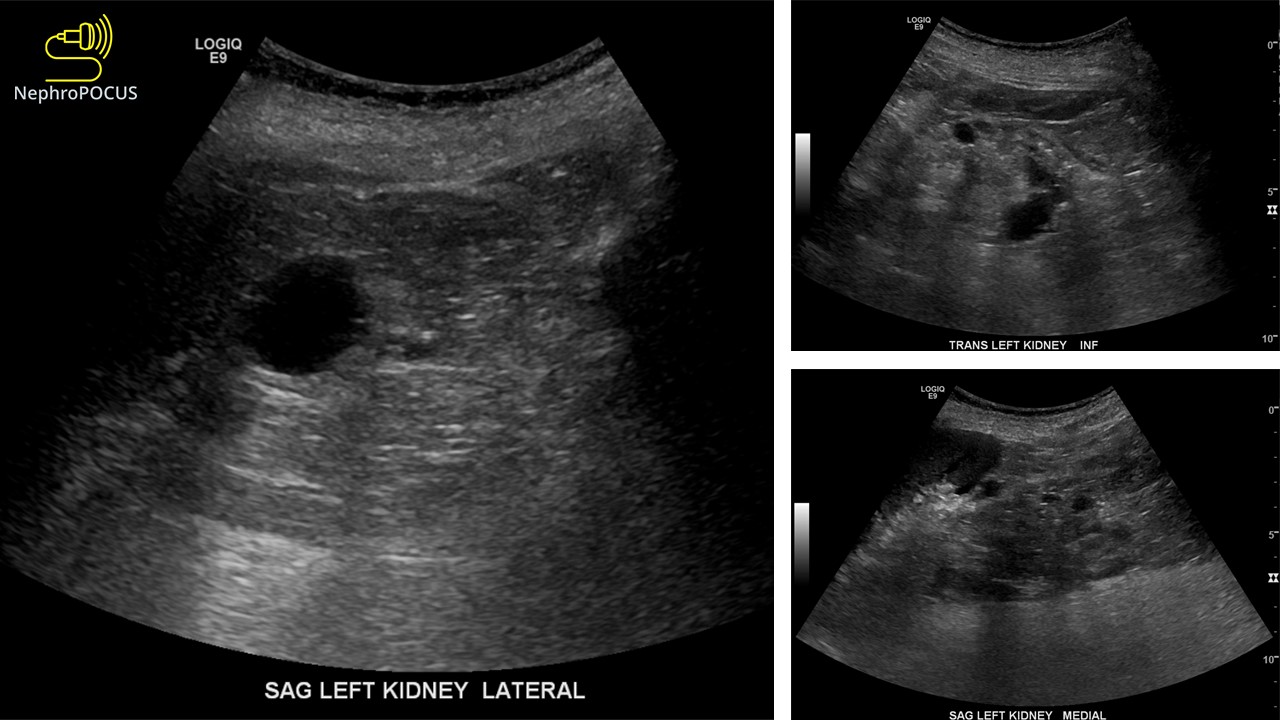 Multiple cysts in the kidneys NephroPOCUS