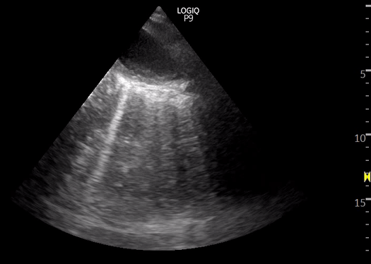 The jellyfish sign: atelectasis – NephroPOCUS