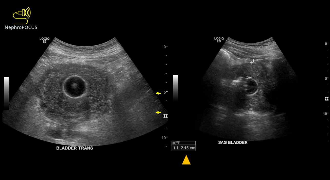 Urinary bladder wall thickness what is the number to remember