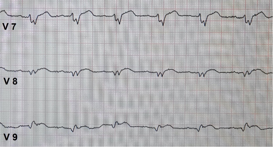 EKGCase Blockbild und unspezifische Beschwerden!? Nerdfallmedizin.de