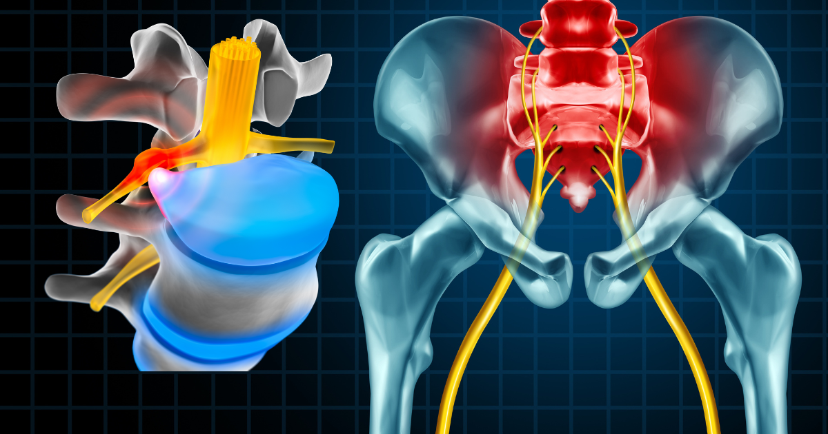 Slipped Disc Treatment Low Back San Antonio Neuropathy Center
