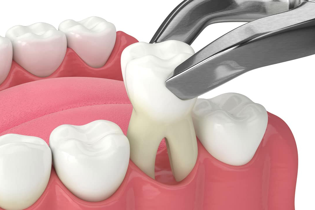 Oral Surgery Procedures in Mooresville, NC Nesbitt Oral & Facial Surgery