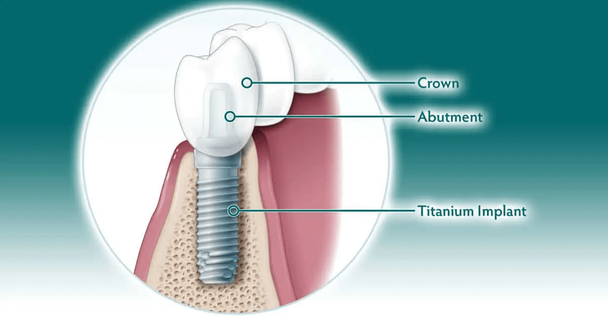 Dental Implants and Bone Grafting in Mooresville, NC Nesbitt Oral