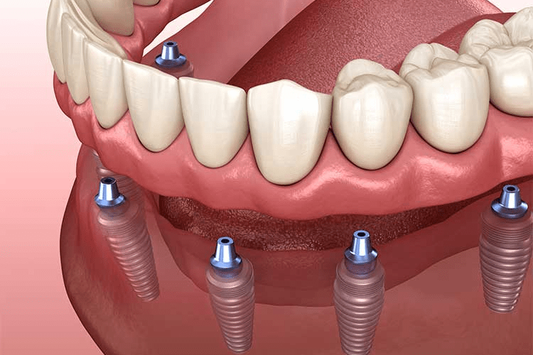 Dental Implants and Bone Grafting in Mooresville, NC Nesbitt Oral