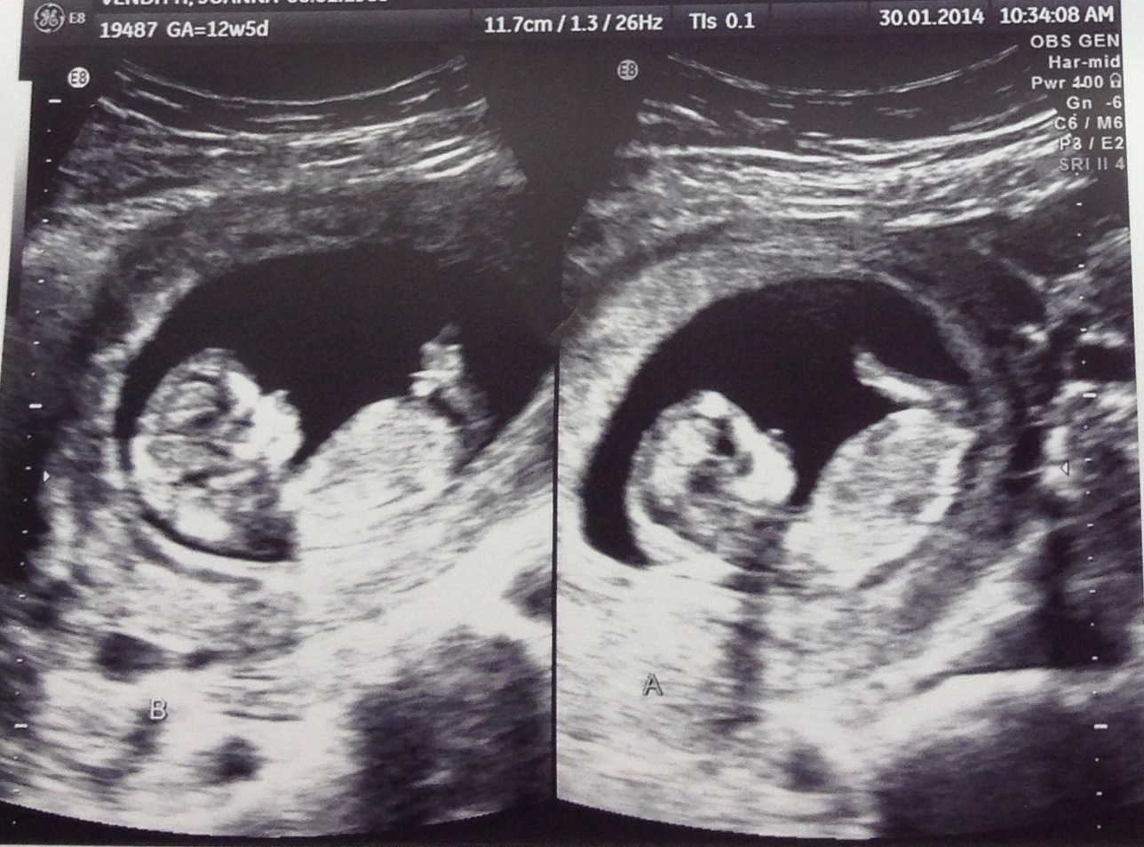 Life Shocker... Twins are on the way! Nesting Story