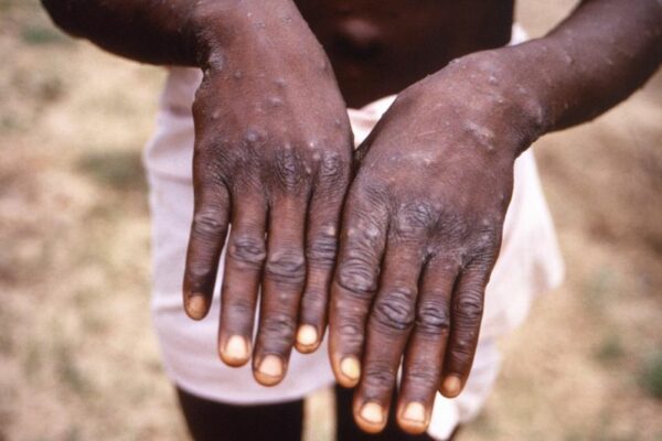 CDC Confirms U.S. Case of Monkeypox NETEC